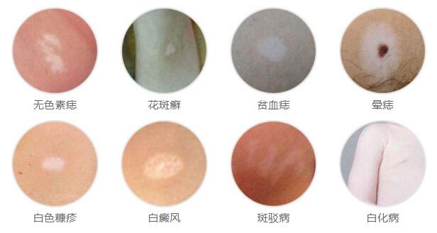 6岁的儿童背部有片白癜风怎么办?