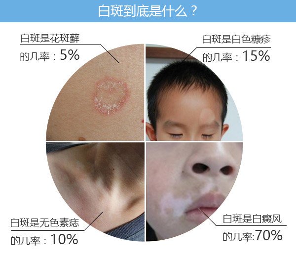 脸部的白癜风有什么症状？南昌治白癜风最好的医院