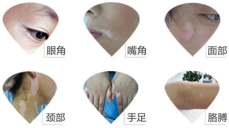 如果出现白癜风有哪些明显的症状?