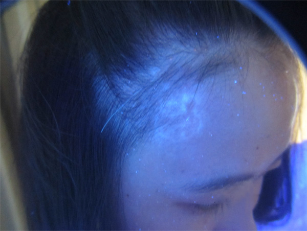 白癜风症状