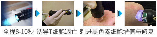 九江早期治疗白癜风用激光还是药物