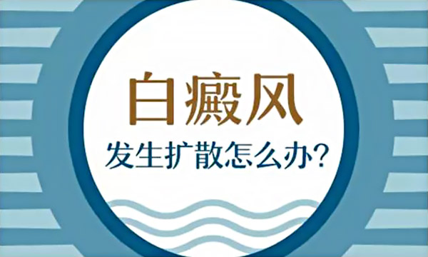 杭州预防白癜风的扩散应该怎样做才比较好