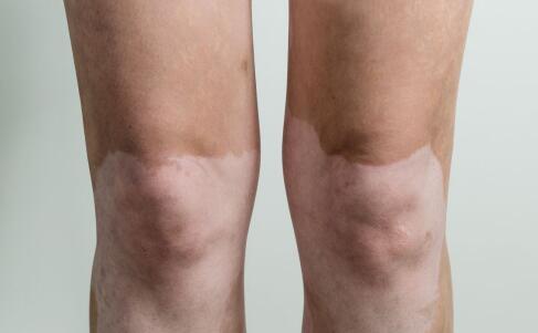 腿部白癜风的主要症状有哪些