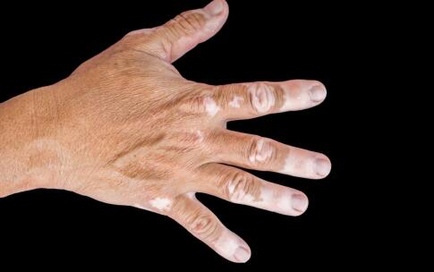 白癜风患者如何治疗手部白斑?