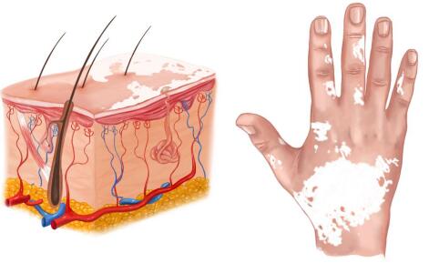 手上的白斑怎么治才会有效?