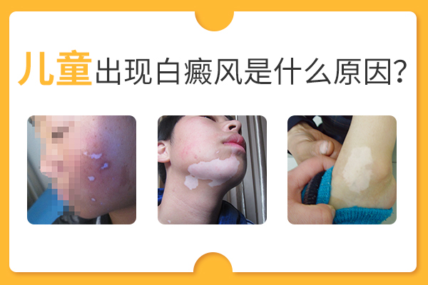 孩子为什么会患白癜风?