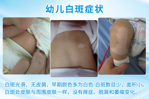 苏州白癜风医生,儿童患上