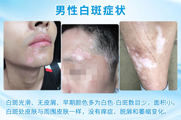 男性白癜风的症状有哪些呢?