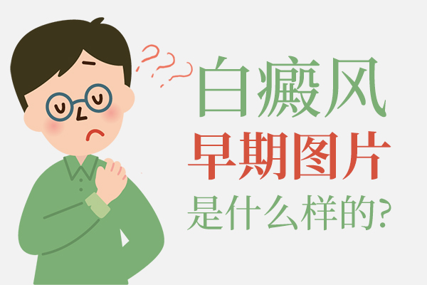 苏州白癜风医院治疗,白斑