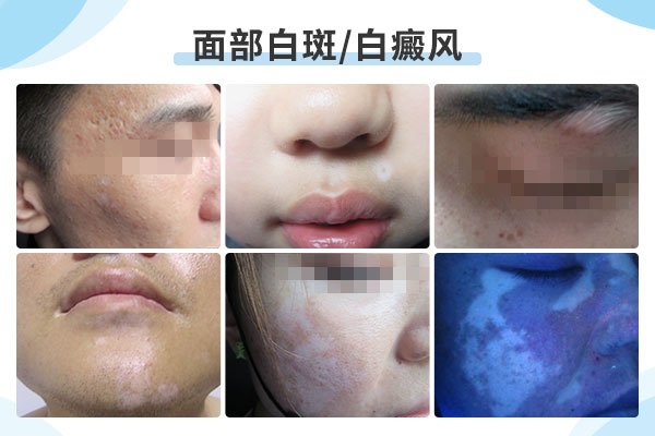 早期面部白癜风有什么症状?