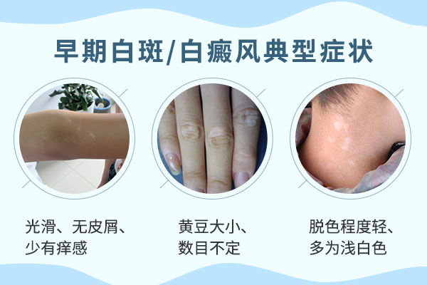 了解白癜风早期的临床症