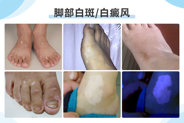 九江引发患者手脚出现白癜风的原因