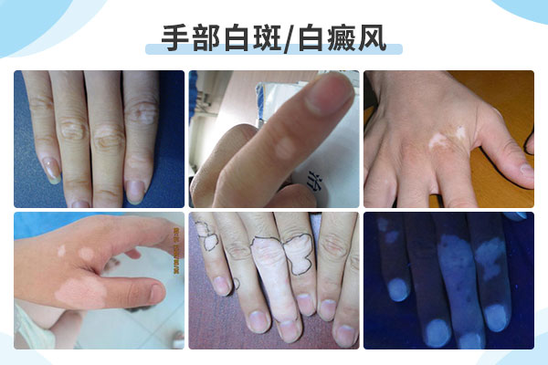 白癜风出现在手背上有什么症状?