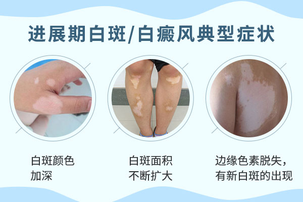 白癜风晚期有哪些明显症状?