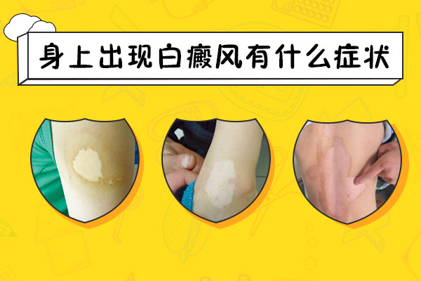 初期白癜风的症状表现是什么呢？
