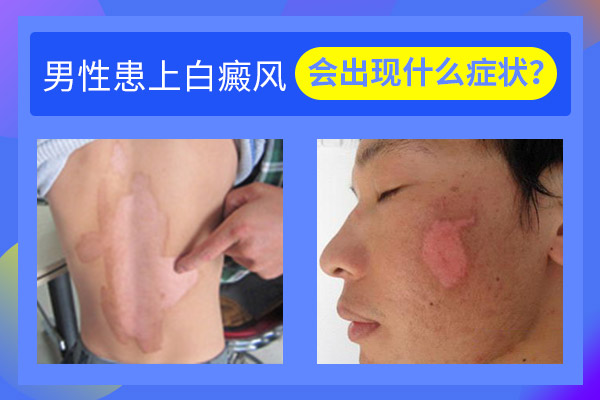 男性白癜风患者有什么症状?
