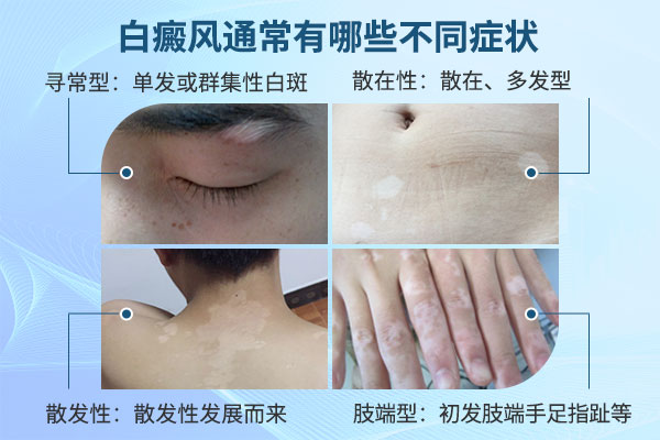 白癜风有哪些表现?