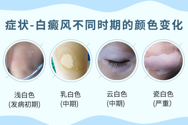 治疗中断对白癜风病情的治疗有何影响?