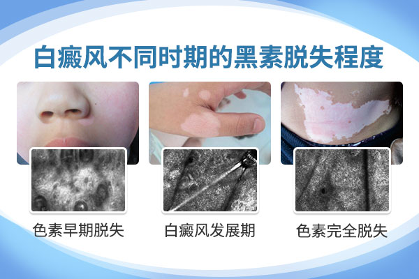 白癜风患者免疫力下降的迹象有哪些？