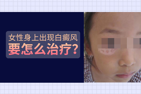 女性治疗白癜风需要注意什么？