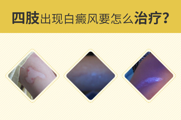手上有白癜风患者需要注意什么？